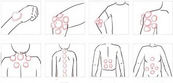 12pcs Mini Silicone Chinese Traditional Medical Cupping Cups