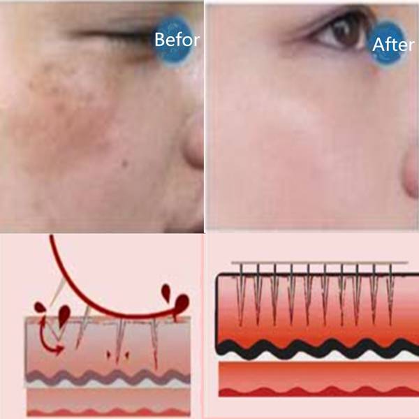 Microneedle Micro Needle Needling Derma Pen Stamp Face Cleaner