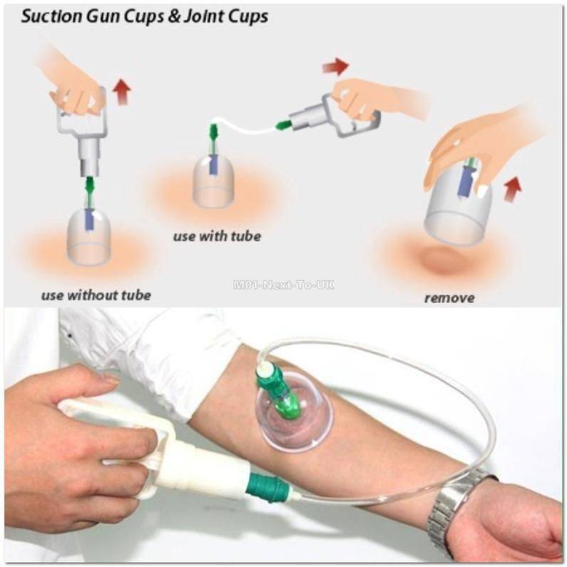 ZS - Vacuum Cupping Sets of 12 Cups With Pump