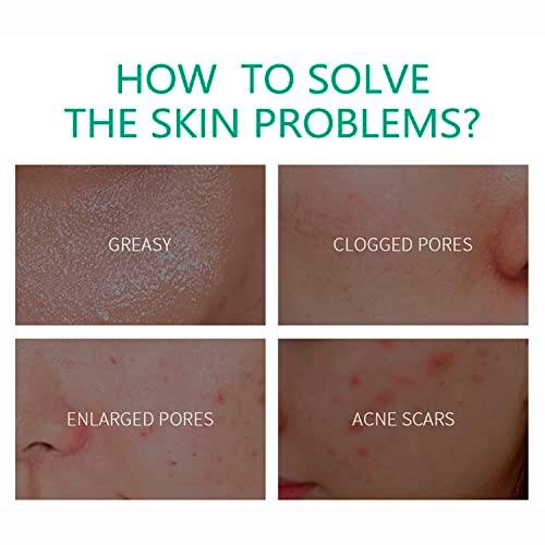 Aichun Beauty Anti-Acne Cream 20g - AC2001