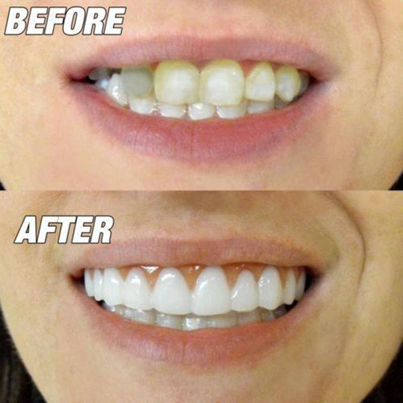 Silicone Whitening Simulation Braces Comfort Fit Flex Curved Teeth Dentures Beauty Tools, Length:...