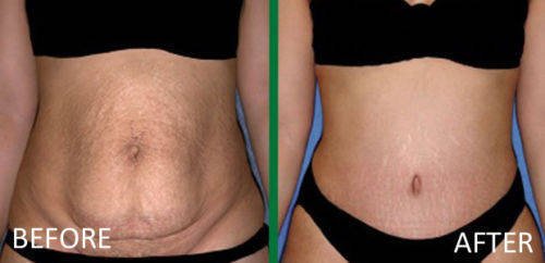 Tummy Tuck Slimming System