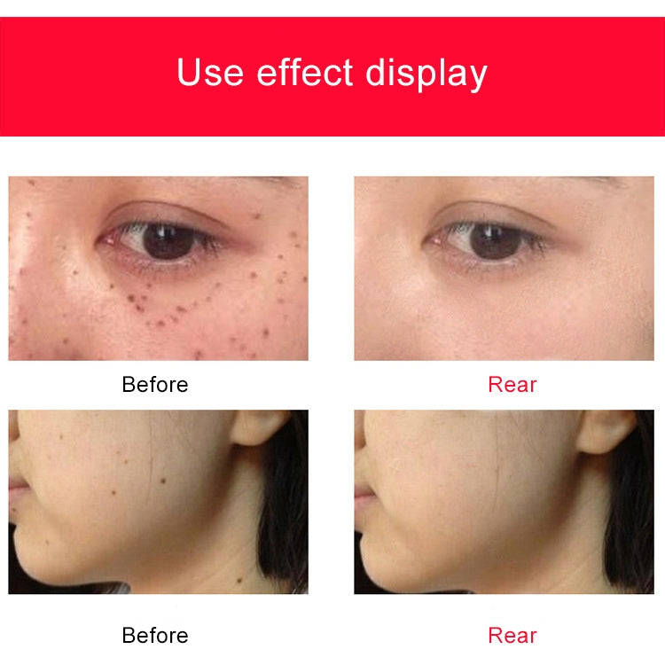 SONGSUN X2 Professional Portable Skin Spot Tattoo Freckle Removal Machine Mole Dot Removing Laser...
