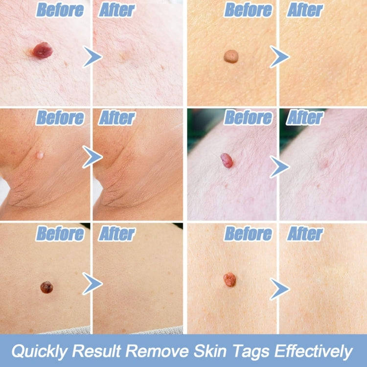 Skin Tag Removal Tool For 2mm-4mm Skin Tags Without Acne Patch