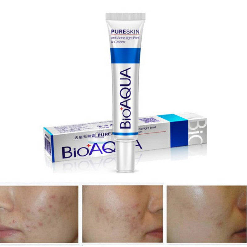 Acne Scar Treatment