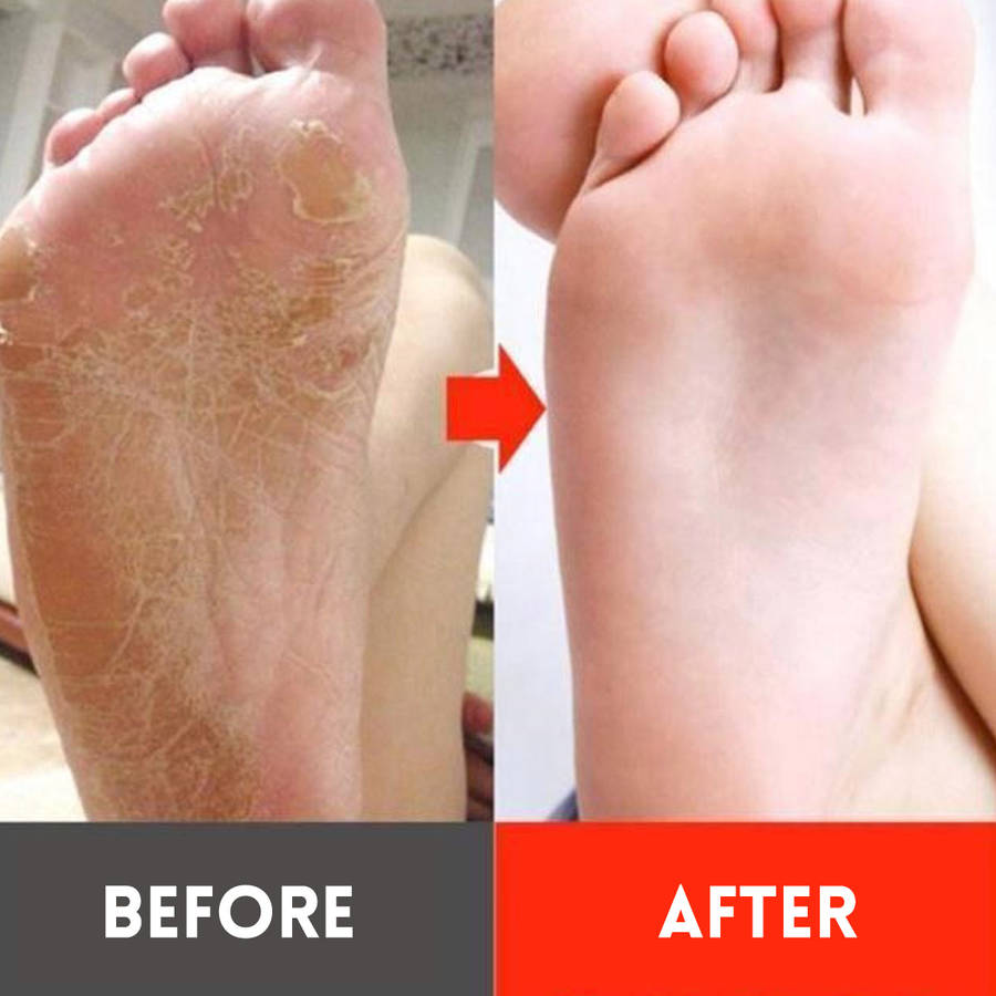 Electric Callus Foot Pedicure Dead Skin Remover Electric Grinder Vacuum Grinding Kit Tool