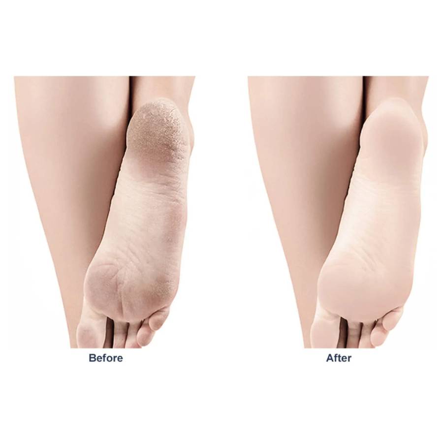 Foot Grinding Artifact