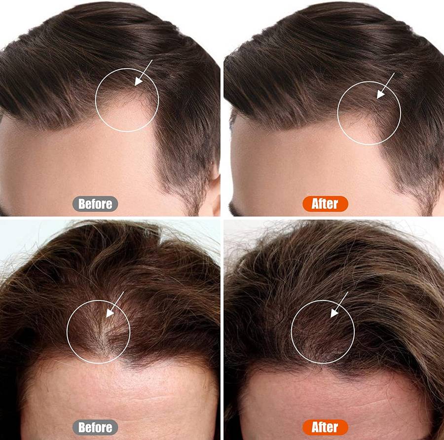 Mens Derma Roller for Beard Growth (0.5mm)