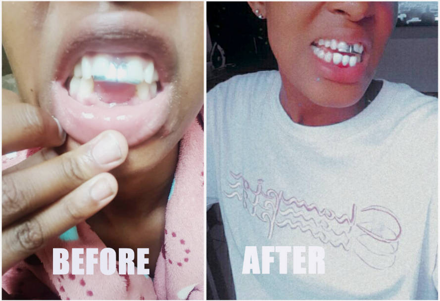 Perfect smile Cut-Able teeth veneers, suitable for top or bottom Cut & Use