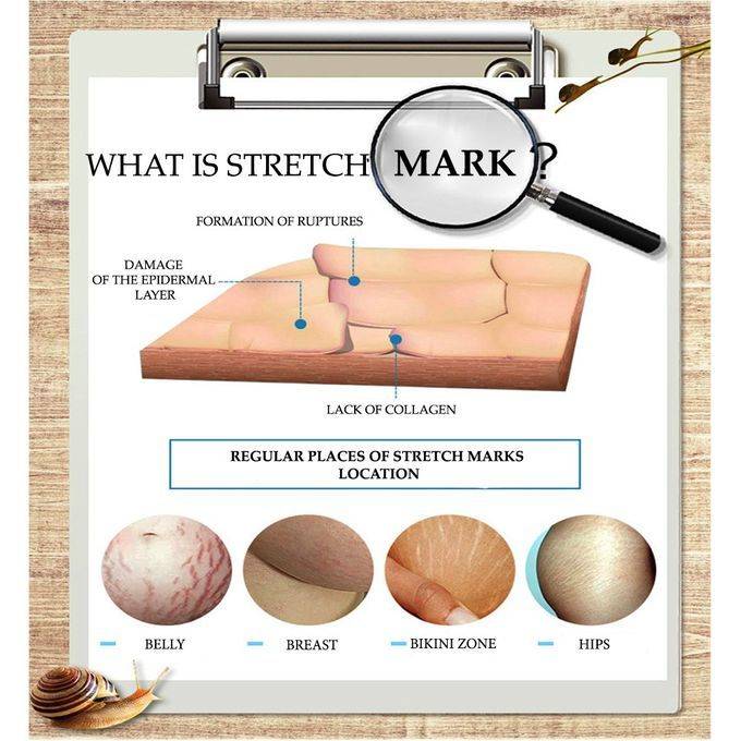 Snail Extract Stretch Mark, Cellulite, Scar Remover Essential Oil 30ml