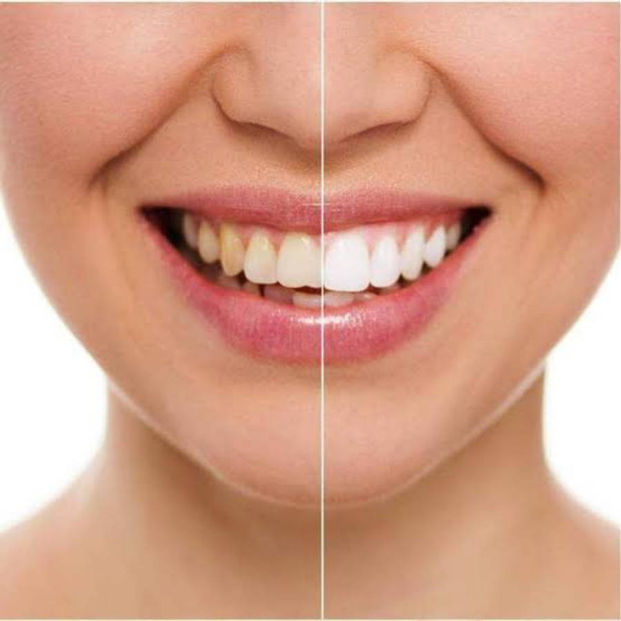 The 20 Minute Dental White Teeth Whitening System