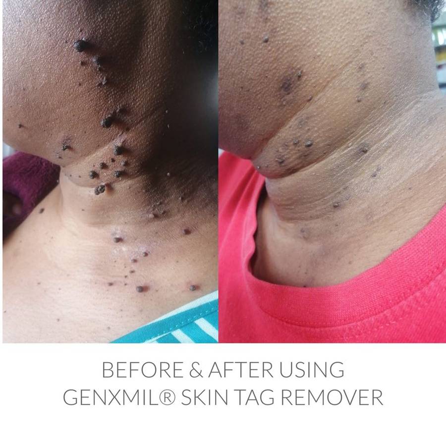 Genxmil Tag Remover