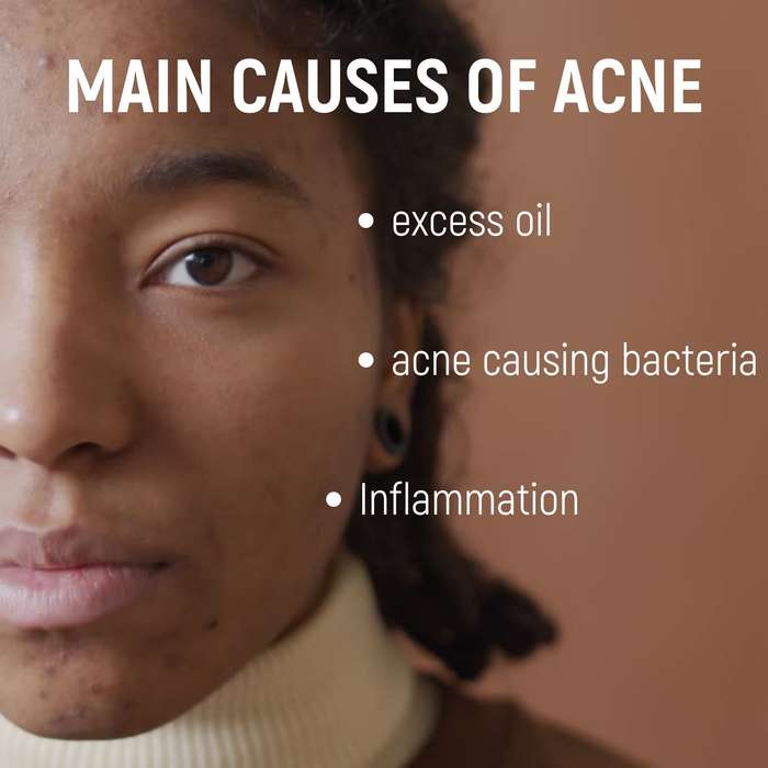 Acne.org.za Moisturise - luxurious moisturiser for Acne-prone skin