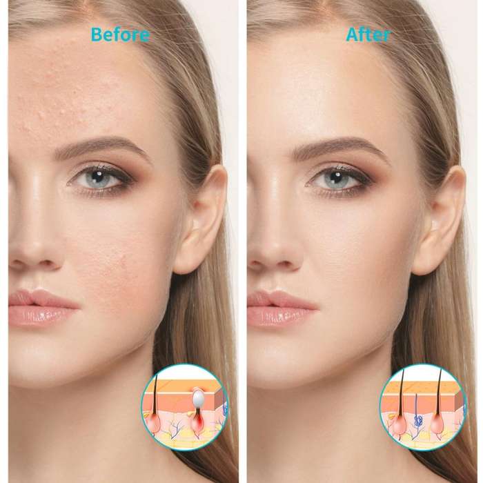 XPREEN XPRE052 Wireless Rechargeable Light Acne Treatment Device Home Acne Clearing Eraser with B...