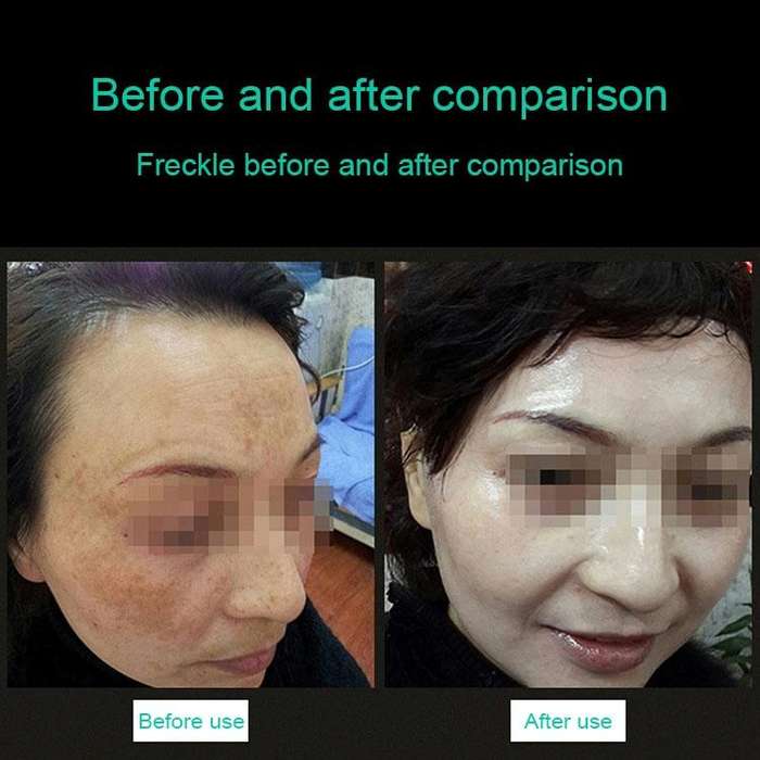 Handheld Picosecond Portable ( Removing Tattoo Freckle Mole Dot) Machine Laser Plasma Beauty Care...