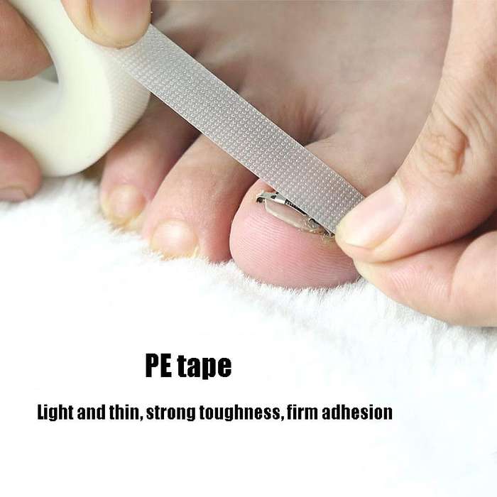 Orthopedic Buckle Toe Nail Groove Ingrown Nail Corrector, Style:No. 44, Specifications:Positive N...