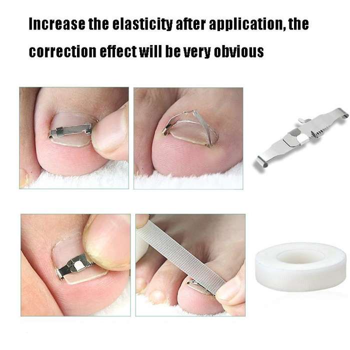 Orthopedic Buckle Toe Nail Groove Ingrown Nail Corrector, Style:No. 44, Specifications:Positive N...