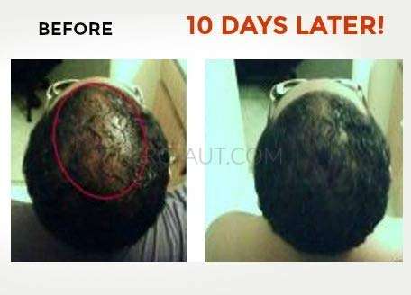 Gro-aut Hair Growth Oil - Herbal Nutrients To Help Fill Bald Patches, Reverse Hair Loss, and Grow...