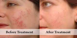 Derma Roller