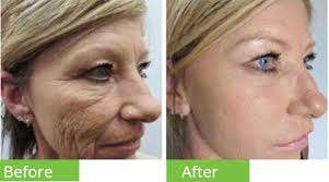 Derma Roller