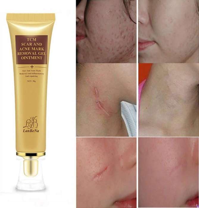 Acne Scar Removal Cream, Skin Repair Cream Scar Cream Gel Scar Treatment for Face and Body Scar Acne