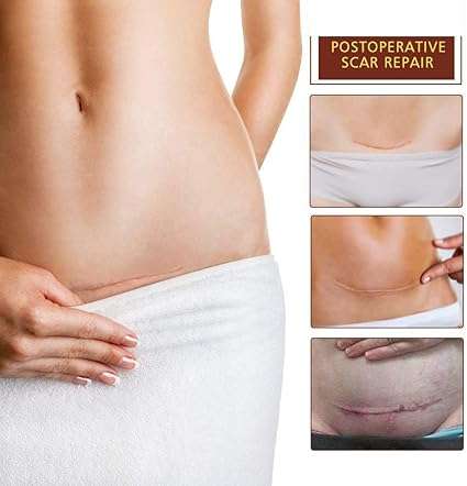 SkinRosa Scar Removal Cream and Acne Treatment Cream - Effectively Remove Acne and Scars like Burns,
