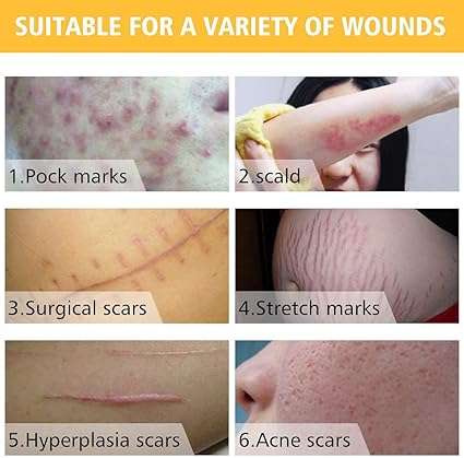 SkinRosa Scar Removal Cream and Acne Treatment Cream - Effectively Remove Acne and Scars like Burns,