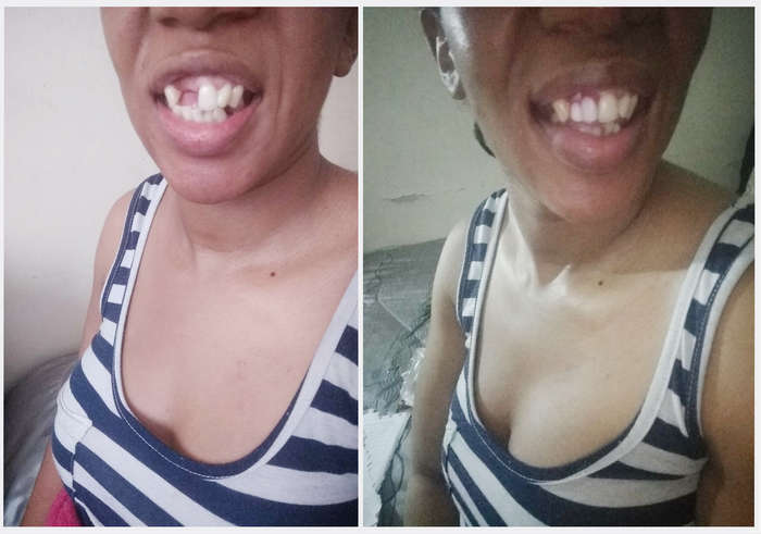 Perfect smile Cut-Able teeth veneers, suitable for top or bottom Cut & Use