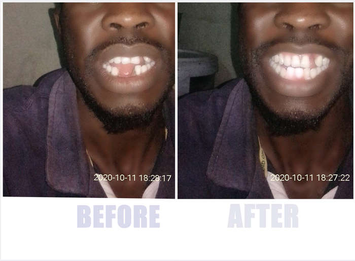 Perfect smile Cut-Able teeth veneers, suitable for top or bottom Cut & Use