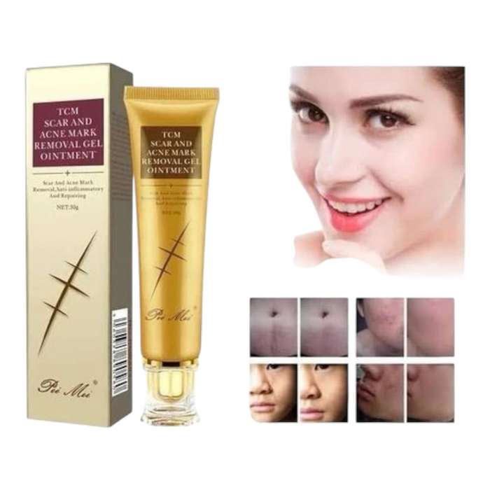 30g Acne Scar Removal Cream