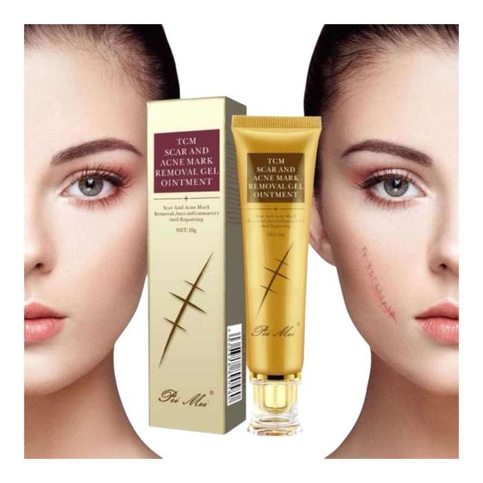 30g Acne Scar Removal Cream