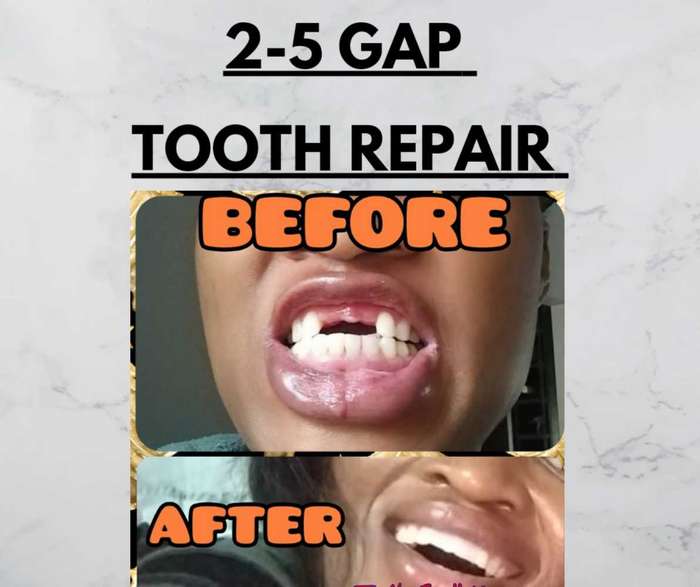 Tooth Repair Temporary Fixer 2 to 5 Fix Kit