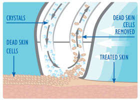 How the crystal renew works