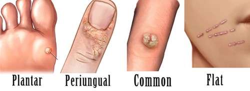 Wart-Remover-Skin-Tag-Mole-and-Genital-Wart-Removal-hpv-Treatment