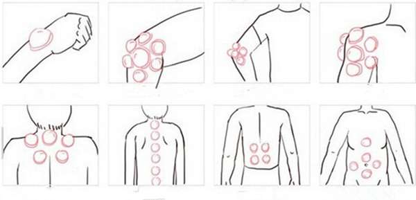 12pcs Mini Silicone Chinese Traditional Medical Cupping Cups