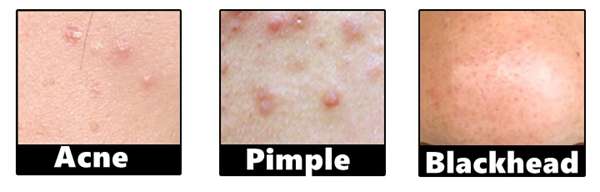 Detachable Acne Blackhead Pimple Extraction Needle Removal Pin