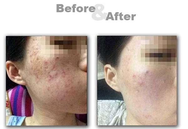 Detachable Acne Blackhead Pimple Extraction Needle Removal Pin