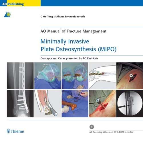 Minimally Invasive Plate Osteosynthesis (MIPO) - G On Tong