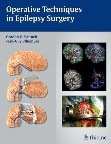Operative Techniques in Epilepsy Surgery - BALTUCH,GH
