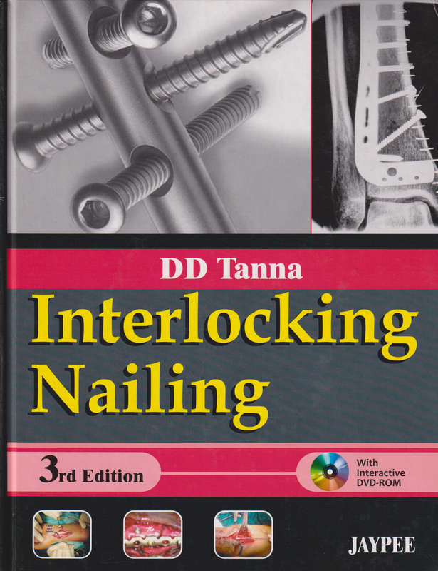 Interlocking Nailing - D. D. Tanna