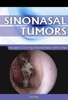 Sinonasal Tumors - Alexander G. Chiu
