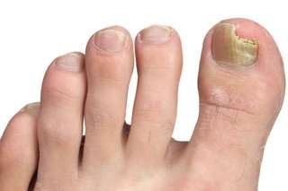 Anti-Fungal Nail Treatment 50ml