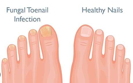 Anti-Fungal Nail Treatment 50ml