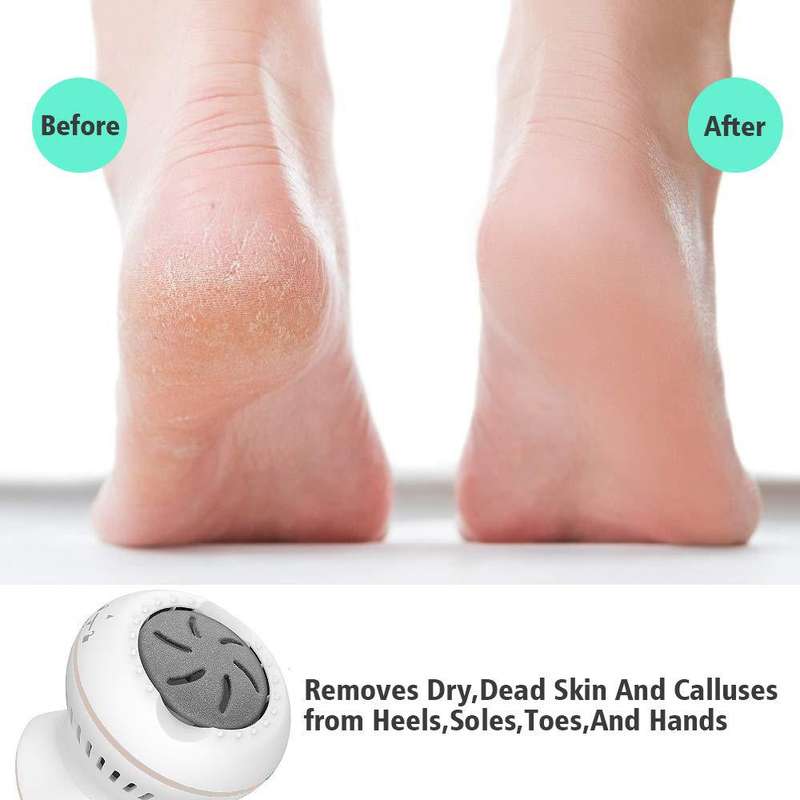 Igia Callus Remover