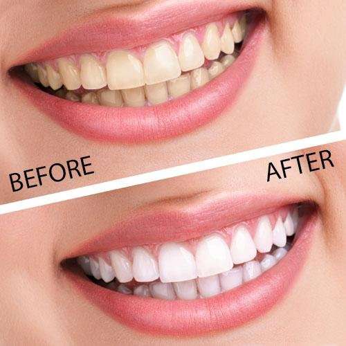 Remedy Health Professional Teeth Whitening Home Kit