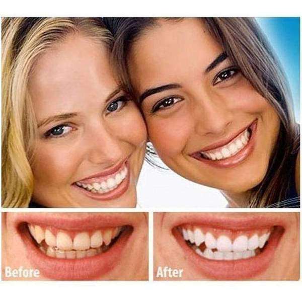 WhiteLight - Teeth Whitening System