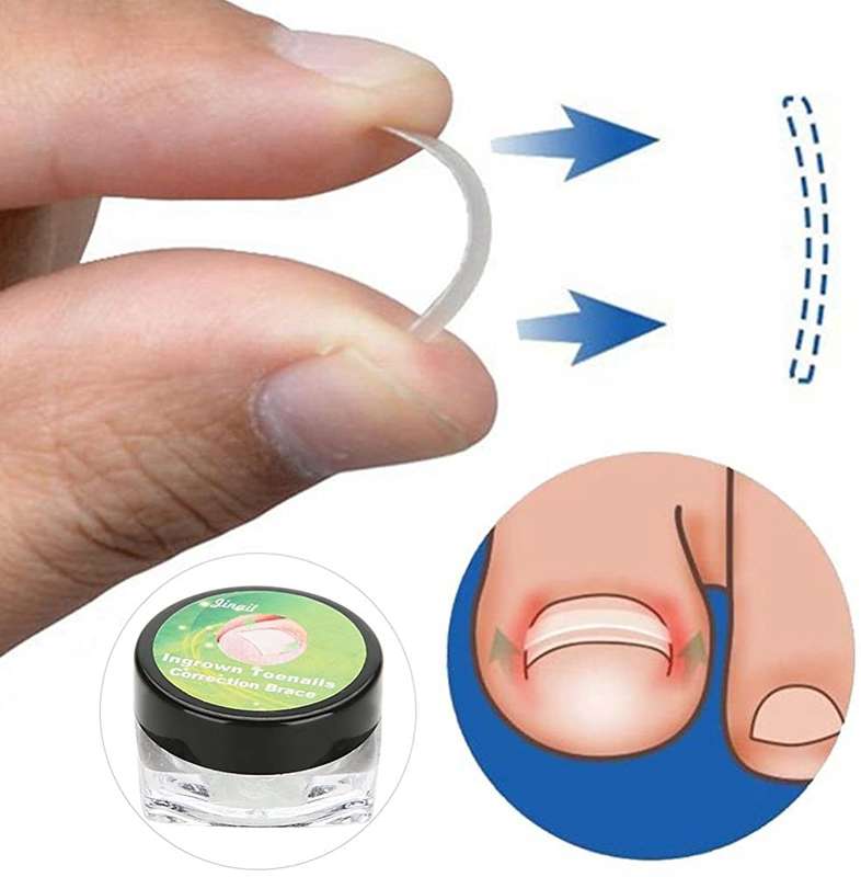Ingrown Toenail Correction Brace - 12pcs