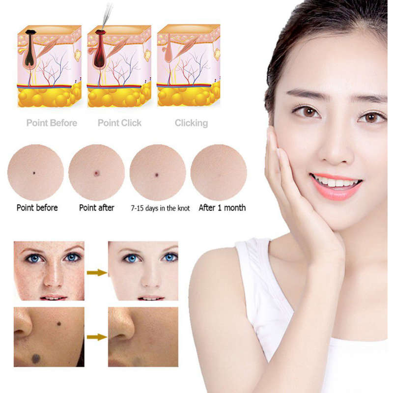 LCD Laser - mole, freckle and Wart remover pen