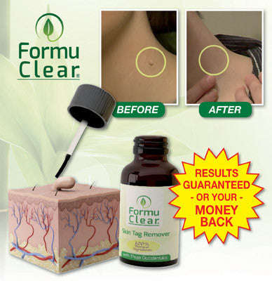 Formu Clear Skin Tag Remover - Easy and Painless!