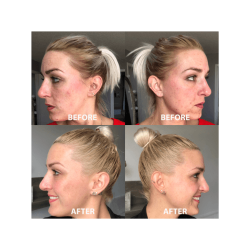 Truly Clear Acne Bar